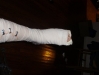 leg_splint