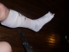 leg_splint2